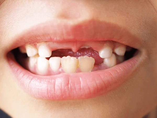 Nằm mơ thấy bị rụng răng có ý nghĩa gì, báo may hay rủi?